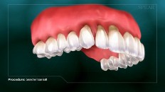 teeth with receding gums