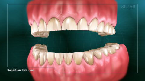 dental erosion thumbnail