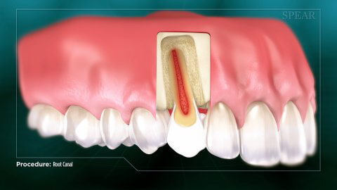 Root Canal thumbnail